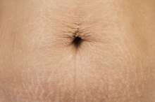 Can You Remove Stretch Marks With Bleaching Cream?