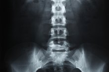 The End Stages of Degenerative Disc Disease