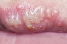 Causes of Cold Sores Other Than Herpes