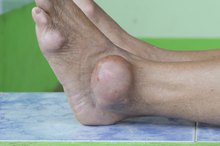Home Remedies for Gout Flare Ups