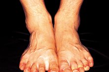 What Causes Red Skin on Feet & Ankles?