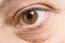 Do Dark Circles Under the Eyes Mean an Iron Deficiency?