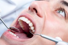 Alternatives for Root Canals