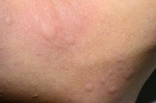 Symptoms of an Iodine Allergy