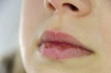 Treatment for Itching Caused by Herpes