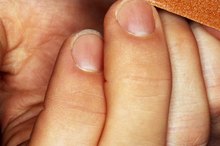Black Lines in Fingernails & Heart Disease