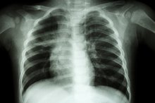Respiratory Splinting: Splinting to Help You Breathe