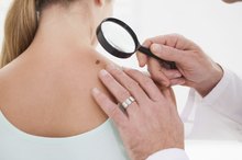 What Causes Dark Spots on the Arms & Shoulders?