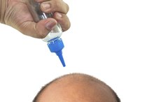 How to Treat Acne on a Bald Head