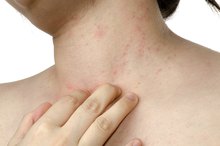 Causes of Itchy Red Bumps on the Neck