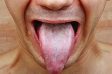 What Are the Causes of Tongue Fungus?