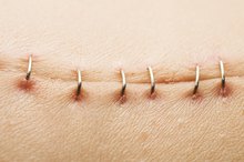 How Long Do Surgical Staples Stay In?