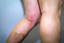 Causes of Only One Lower Leg Swelling With Pain