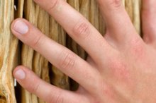 Splits in Fingers Due to Vitamin C Deficiency
