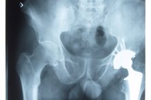 Stretching & Contraindications for Hip Replacement
