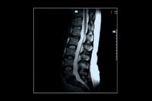 Spinal Stenosis Symptoms in C6 & C7