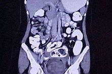 What Is a Pelvic CT Scan?