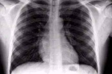 What Does a Smoker's X-Ray Look Like?
