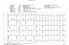 How to Read an Abnormal EKG