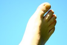 Have Heel Spurs? How to Strap Your Foot