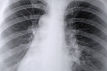 What Are the Causes of Infiltration of Lungs?
