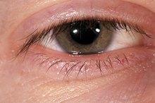 What Are the Causes of Swollen Eyes & Face?