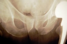 What Are the Treatments for Hip Pain After a Fall?