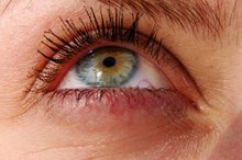 Dermatologist Removal of Dark Circles Around the Eye