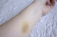 How to Get Rid of a Hematoma