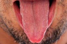 How to Heal Tongue Sores