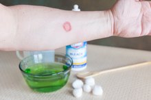Use of Clorox in Treating Ringworm