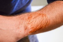 How to Remove Betadine Stains From Skin