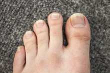 Infected Toe Treatment