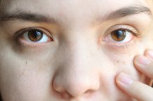 How to Reduce Eye Redness