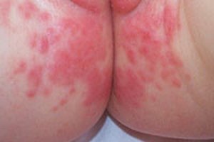 Erupción anal y perianal.