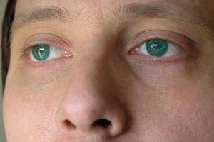 El magnesio puede mejorar la circulación sanguínea periférica y la visión en pacientes con glaucoma.