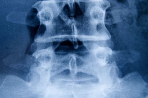 La espondilosis lumbosacra afecta la parte más baja de la columna vertebral.