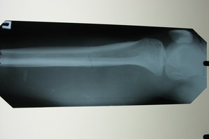 El ejercicio y la densidad ósea.