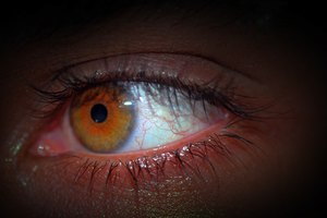 La oscuridad debajo de los ojos es causada por vasos sanguíneos hinchados.