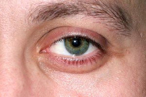 La degeneración macular relacionada con la edad puede causar deterioro de la visión.