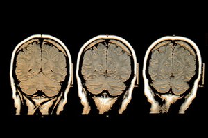 Las convulsiones focales provienen de diferentes partes del cerebro.
