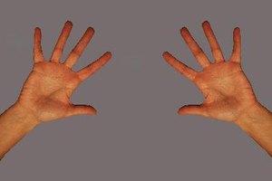El eczema genera picazón y enrojecimiento e inflamación de la piel.