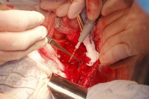 Cirugía de extirpación de un tumor canceroso.
