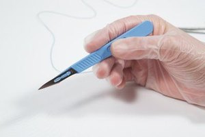Una colecistectomía es necesaria cuando se forman cálculos biliares en la vesícula que causan dolores e inflamación.