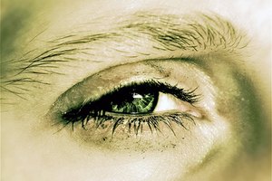 La blefaritis es una inflamacíon de los margenes de los párpados.