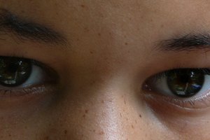 La piel afroamericana es más susceptible a las ojeras debido a un aumento de la producción de la melanina.
