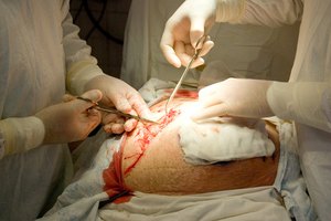 Algunas heridas requieren de cirugía para reparar el daño.