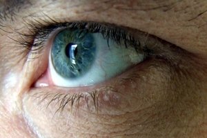 La iInflamación de la córnea puede crear distorsiones visuales.