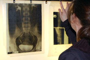 Distensión abdominal.