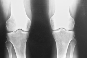 Las rodillas postoperadas saludables necesitan ejercicio.